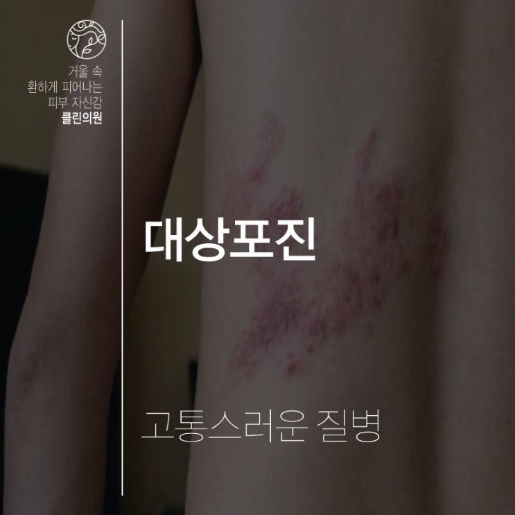  김천혁신도시 고통스러운 대상포진 치료는 어디서?