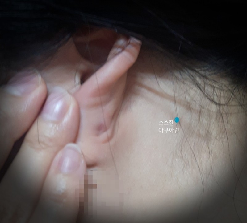 귀 피지낭종 제거 수술 치료 후기 : 네이버 블로그
