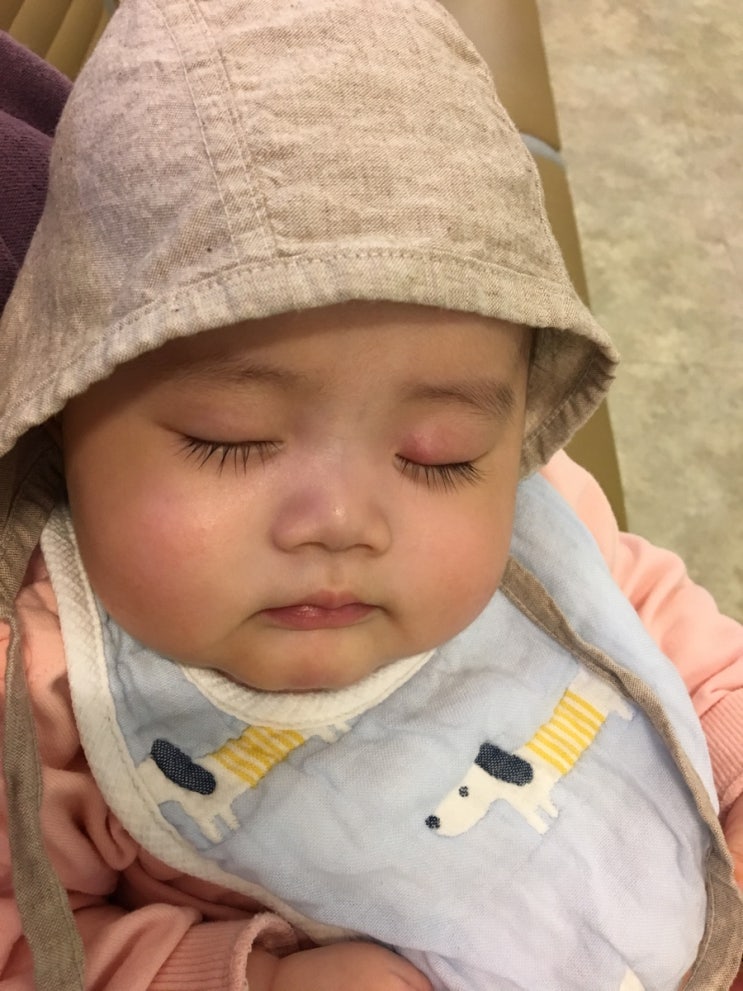 [아기다래끼] 4개월아기 심한 첫다래끼 탈출기 찜질방법, 치료기간, 안과병원