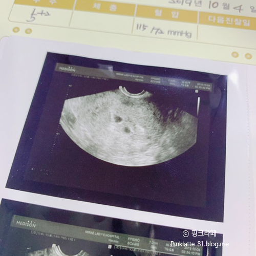  191004 5주 2일차 “쌍둥이임신” 이란성쌍둥이.. 아기집 확인하고 온 날~~