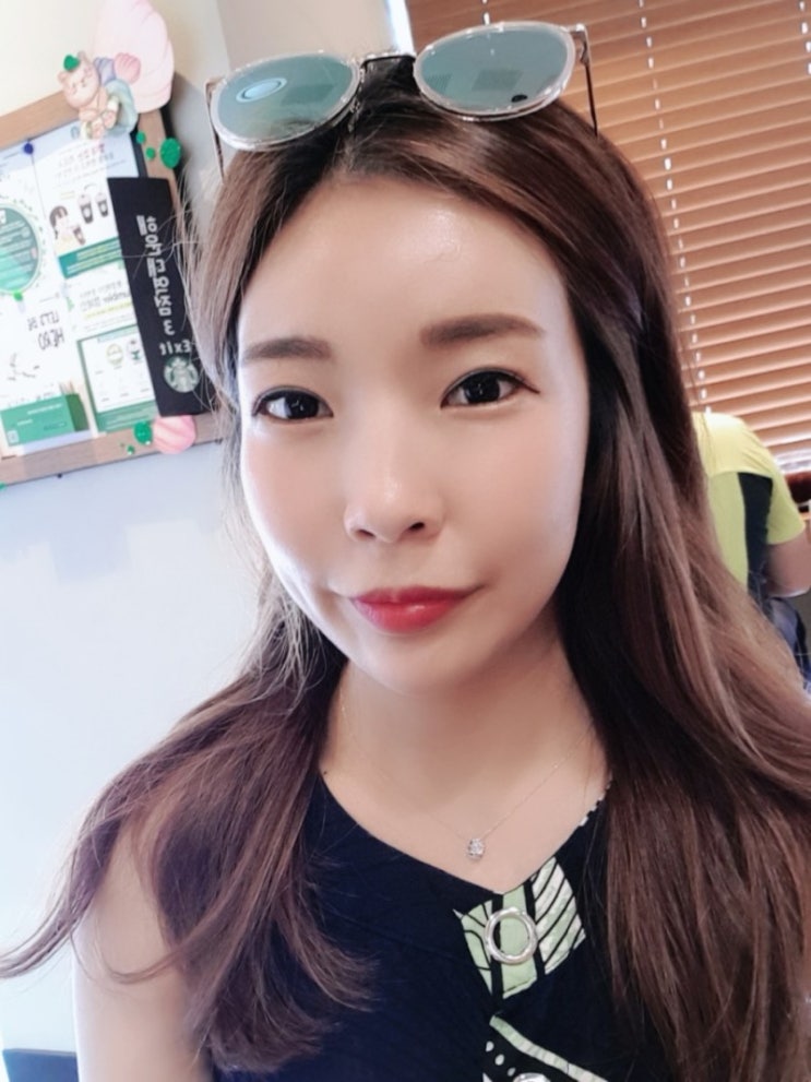 이마필러 리터치까지 안전하게 볼륨감 채우기!(전, 후 사진) 이마필러 리터치까지 안전하게 볼륨감 채우기!(전, 후 사진)