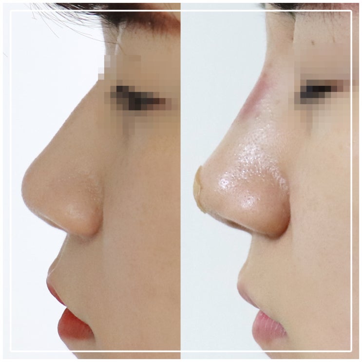  화곡역피부과 추천 하이코후기 필러 시술