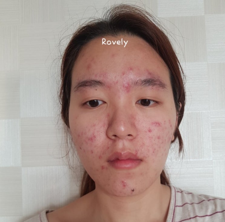  화농성여드름치료 3주,4주차 /모낭염감소 /한달간 6키로감량 /당,밀가루,유제품 끊기의 중요성