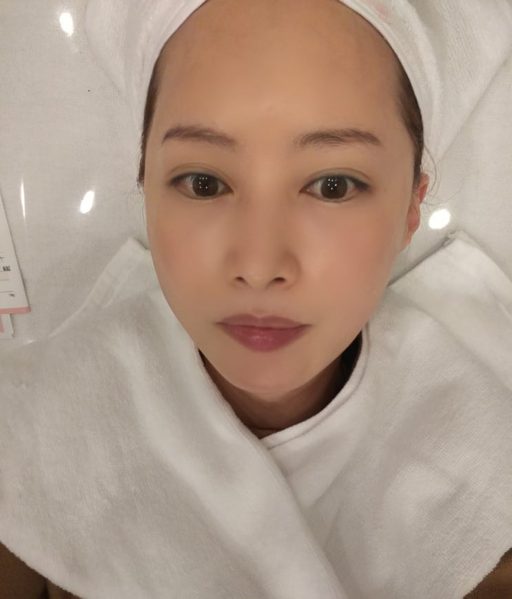  피코토닝 기미제거 피코레이저 후기