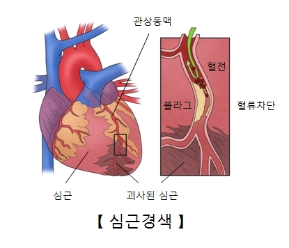  심근경색 이란 무엇인가?
