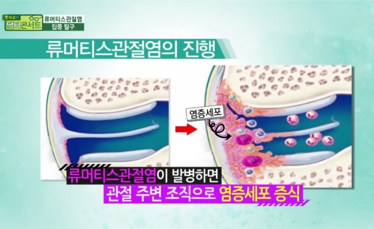  관절염.류머티스관절염.통증.항염증.오일.아로마테라피.자연치유.