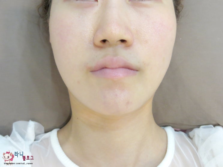  신사역피부과 모공관리&신데렐라주사 후기!