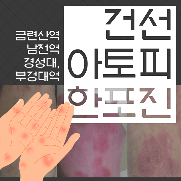  아기땀띠와 아토피의 차이점! 전혀 다른 피부발진입니다.