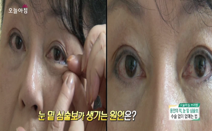  MBC 생방송 오늘 아침, 동안의 적 눈밑지방, 눈 밑 심술보 없애는 마사지법