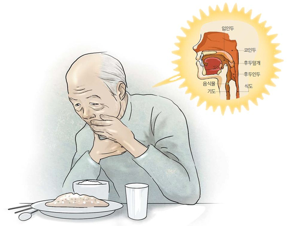  삼킴장애(연하곤란)의 원인과 재활치료