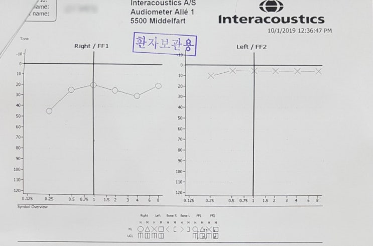  돌발성난청/귀먹먹할때/응급질환/바로 병원가세요ㅠㅠ