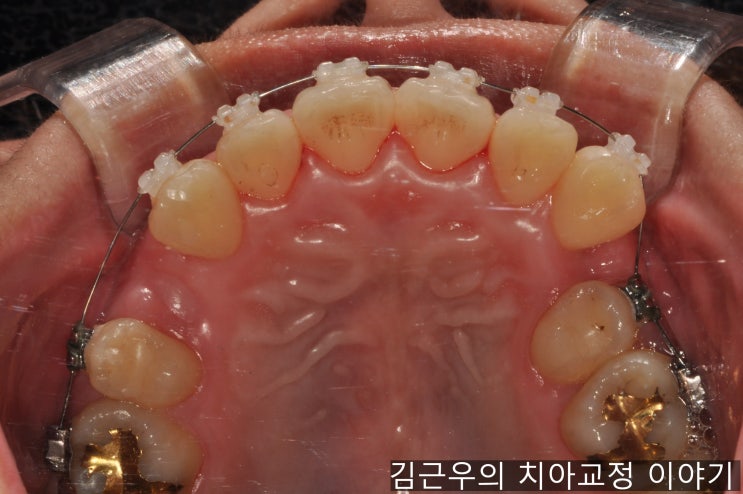  덧니 발치 교정