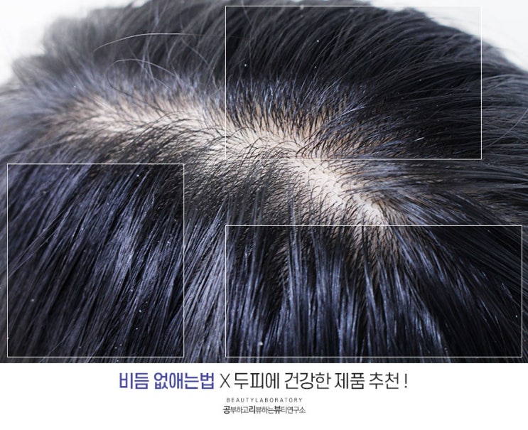  비듬 없애는법 원인알고 건강두피 되찾은 후기