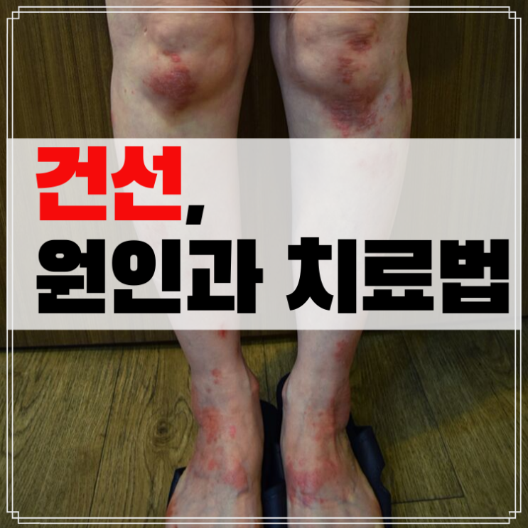  <대전건선치료> 팔꿈치, 다리 건선이 생기는 원인과 치료법은 뭘까?