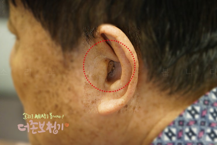  대구 오티콘 보청기, 어르신의 보청기 청소 및 관리가 중요한 이유!