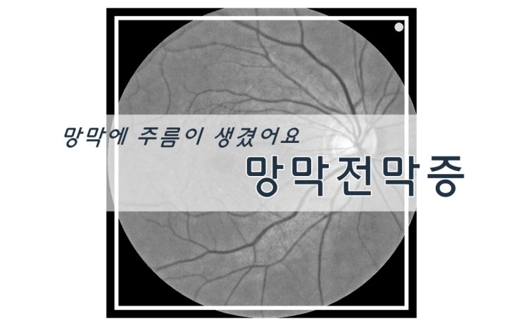  망막에 주름이??! 망막앞막에 주름이 생기는 망막전막증 증상과 치료