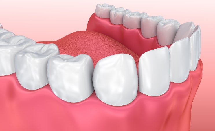 치아교정 잇몸퇴축 시작부터 바로잡기