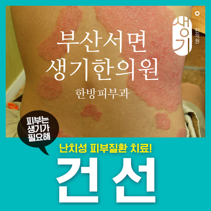  서면건선 치료, 피부에서 각질이 우수수 떨어져요..
