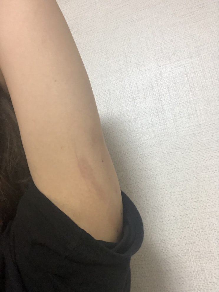  선릉역피부과 본라인의원에서 지방분해주사 팔뚝빼리오 받고 왔어요!