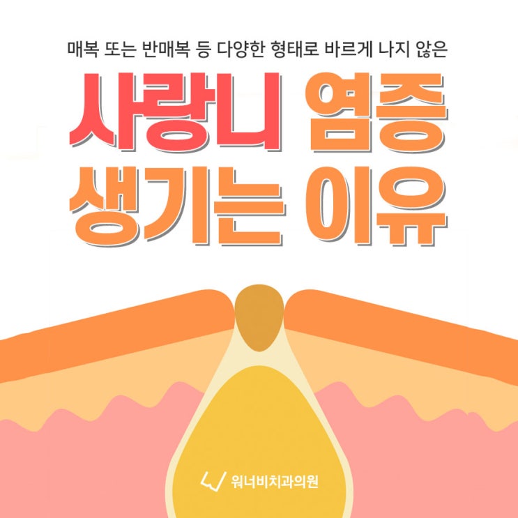  부산사랑니발치치과 매복사랑니는 왜 염증이 쉽게 생기는 건가요?