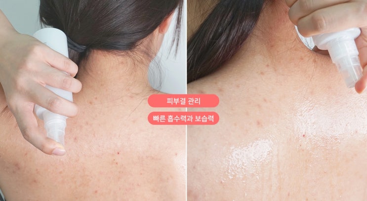 등여드름없애는법 제가 하는건데 공개해요:D