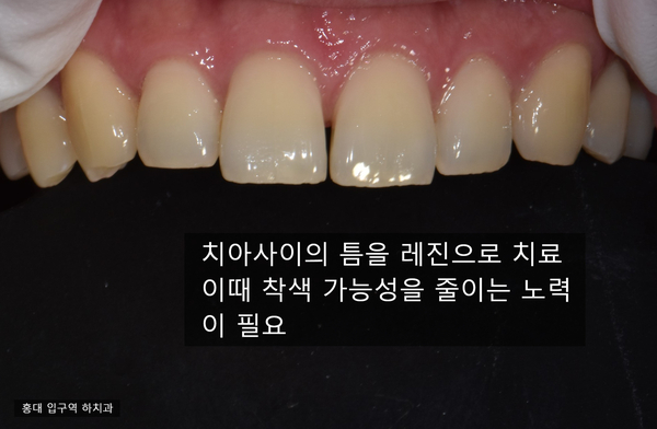  앞니 레진 변색가능성을 줄이려면 어떻게 해야 할까요?