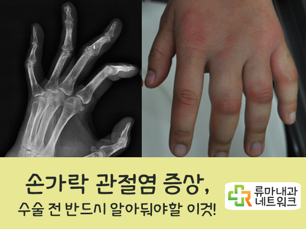  손가락관절염 증상 수술 전 반드시 알아둬야 할 것!!