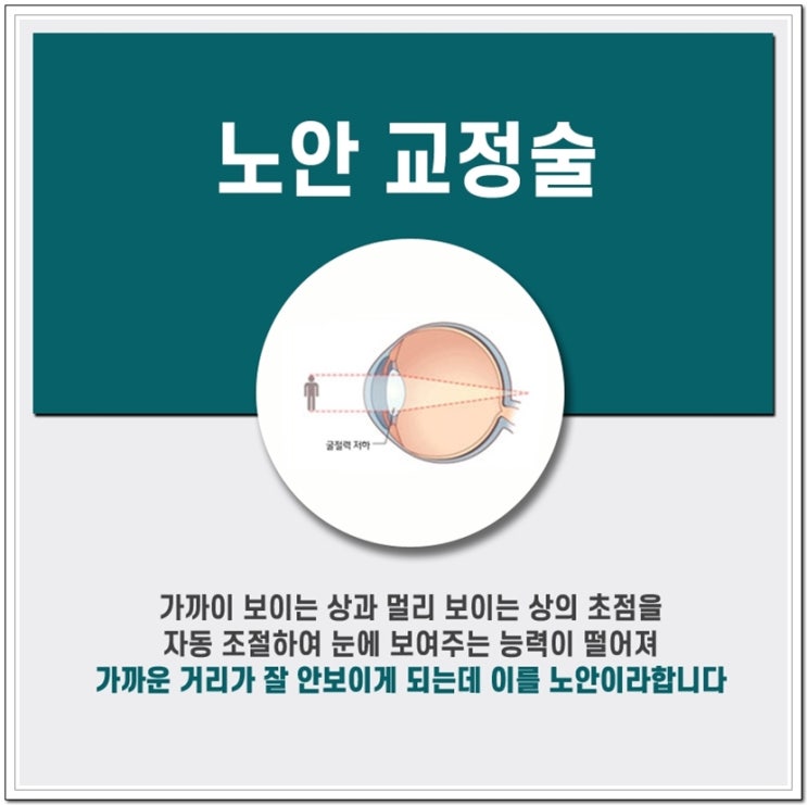  노안교정술 생각만큼 어렵지 않아요!