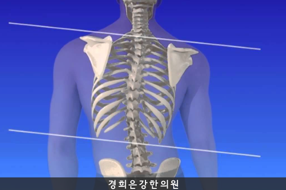  휘어진 척추, 척추측만증 교정하는 방법은?