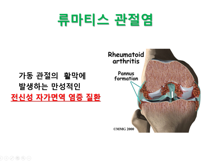  류마티스관절염, 증상과 예방수칙