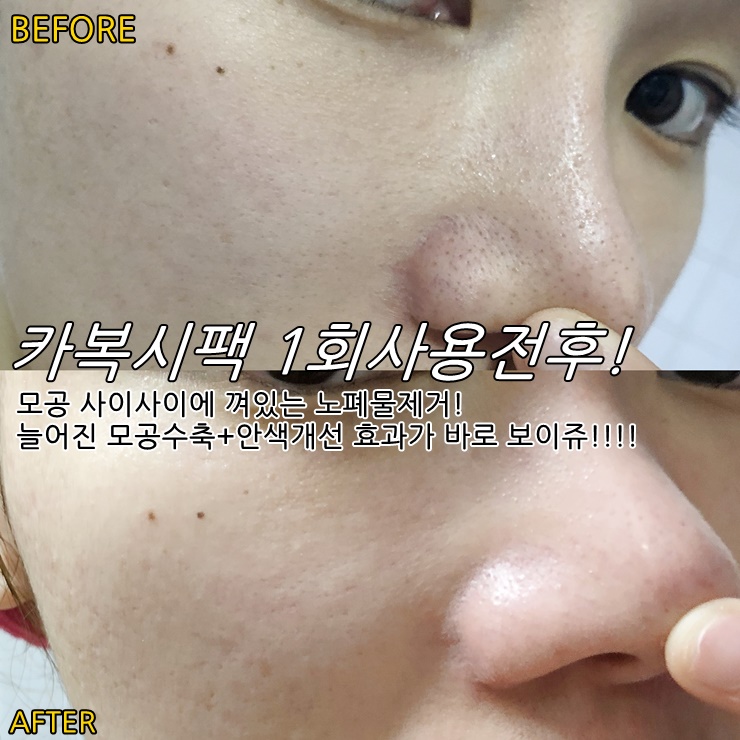  * 고가의 탄산관리!! 메조시스 카복시팩 6개월만의 재입고️ 1회 사용만으로도 드라마틱한 효과를 확인해보세요!(~10/10까지 무료배송+최저가+최다구성 진행!)