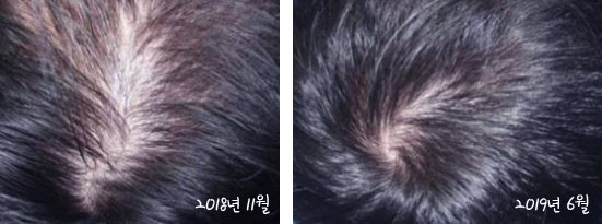  남자정수리탈모 치료 약 성분이 있는 10초샴푸