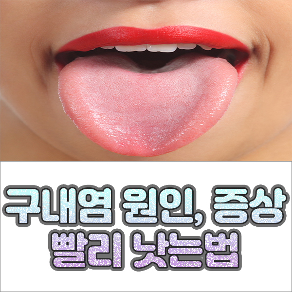  구내염 원인과 증상 빨리낫는법