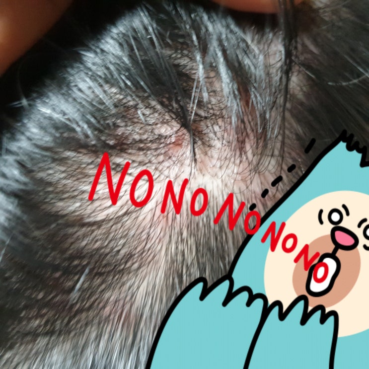  두피 따가움에 머리카락 끝까지 상했던 예전 사진