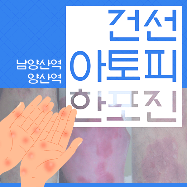  무릎뒤 접히는부분에 자주 발생 [아토피] 가려움증완화