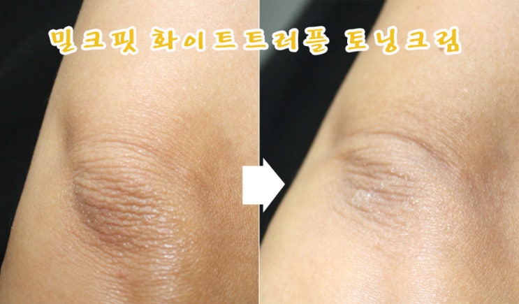  팔꿈치 하얘지는법 화이트닝크림 밀크핏으로 해결해요