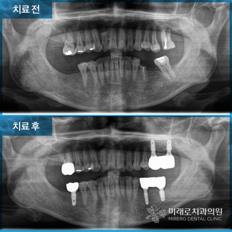  수유역 임플란트 장O숙님 이야기