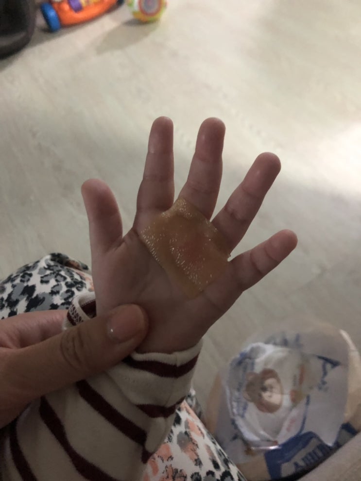  인생 +410일차 육아일기 / 걷기시작 , 어린이집에서 화상입음#