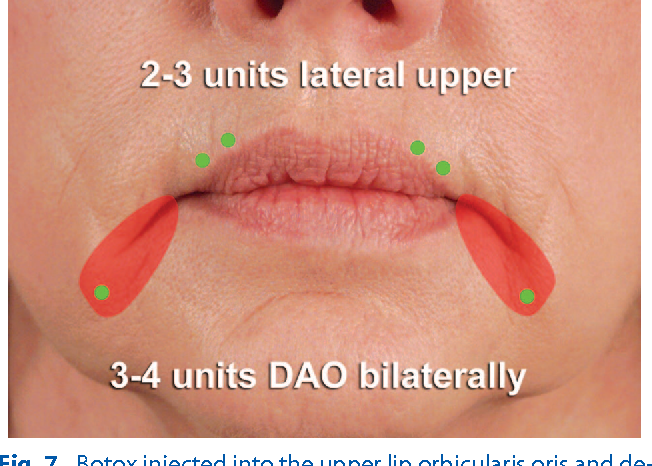 입가 주름 보톡스 : 네이버 블로그