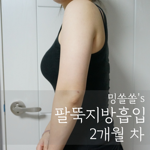  팔뚝지방흡입 두 달 경과 :: 가격 싸게 잘함
