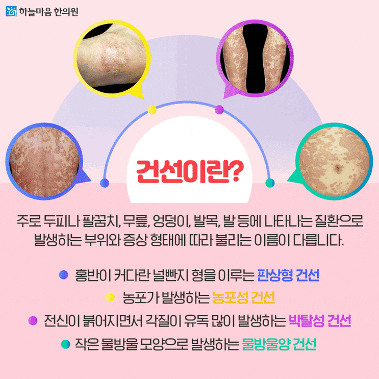  대전건선 관리하지 않았더니