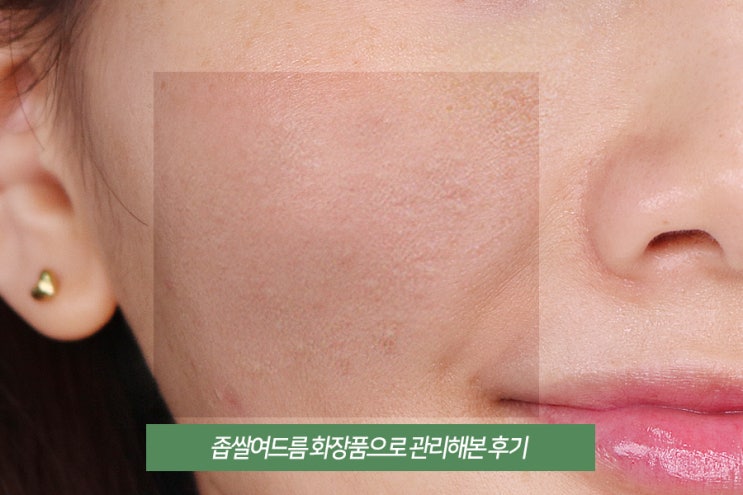  좁쌀여드름 화장품 인생템으로 데일리 케어해본 후기