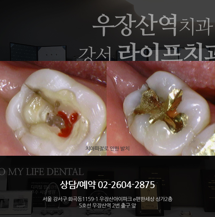  우장산역치과 충치치료 전 여기서 알아보고 해결해보자!
