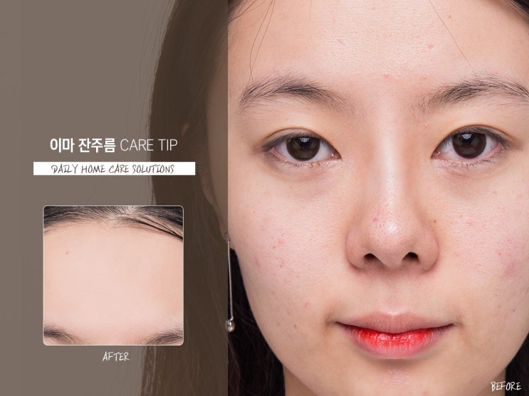  이마잔주름 잡고 얼굴 다잡기(전후ok)