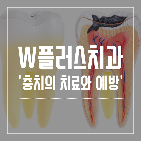  인천삼산동치과 '충치? 치아우식증의 치료와 예방