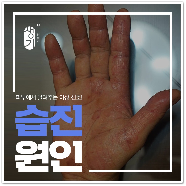  손습진 한의원 원인을 찾아서