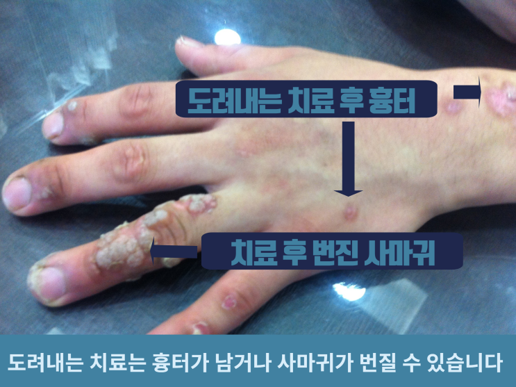  사마귀 치료방법으로 추천