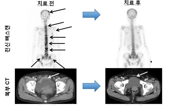  4기 방광암에 '면역항암제' 사용하는 것‥ `방광암` 환자의 장기생존을 직접 본 의사 이야기