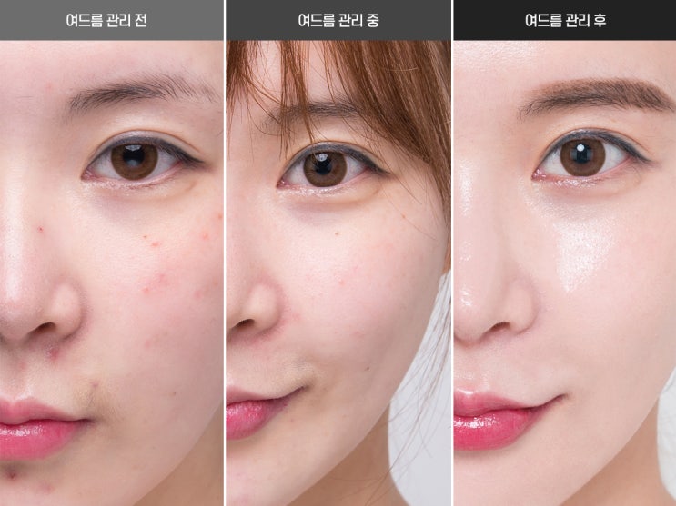  여드름 패치 자극없이 피붓결 구원하기