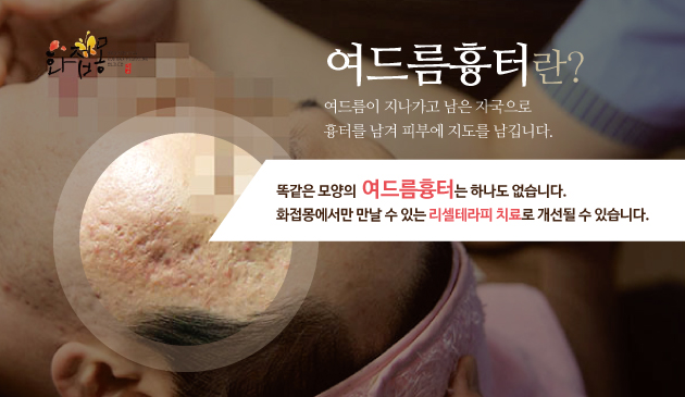  지긋지긋한 신촌여드름흉터 고민 이제 떨쳐낼때!